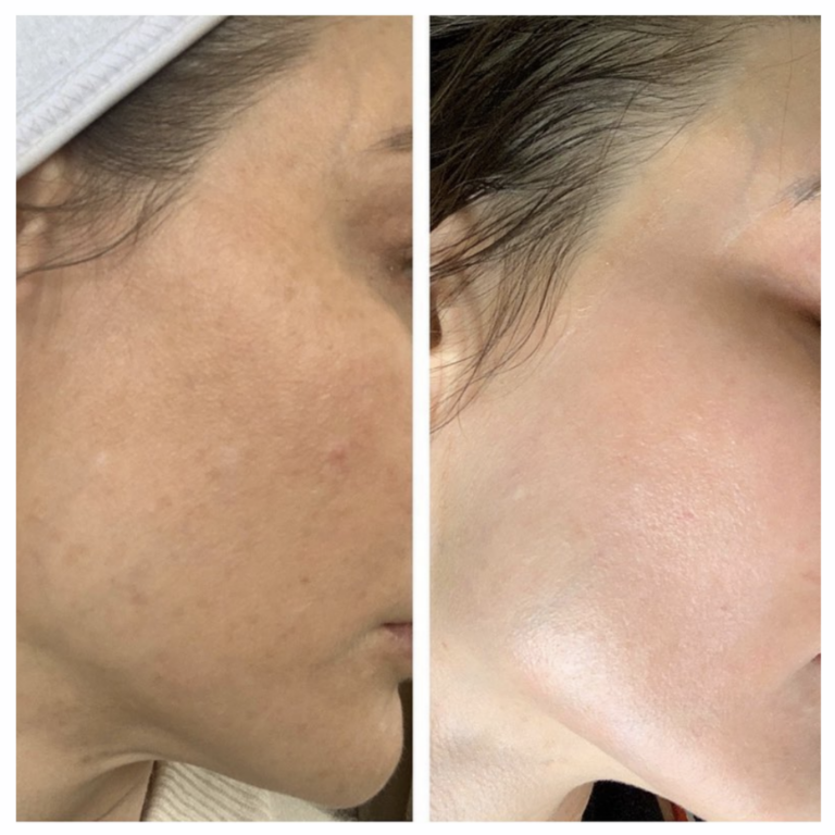 6 Reasons to Treat Pigmentation with Cosmelan - Privée Clinic